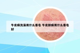 牛皮癣洗澡用什么香皂 牛皮肤癣用什么香皂好
