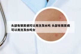 头部有银屑病可以用洗发水吗 头部有银屑病可以用洗发水吗女