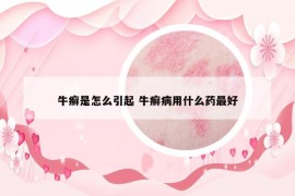 牛癣是怎么引起 牛癣病用什么药最好