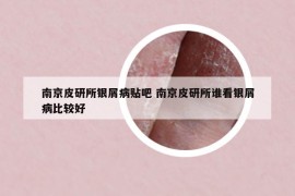 南京皮研所银屑病贴吧 南京皮研所谁看银屑病比较好