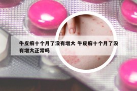 牛皮癣十个月了没有增大 牛皮癣十个月了没有增大正常吗