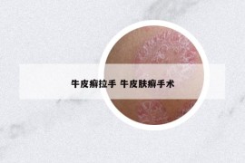 牛皮癣拉手 牛皮肤癣手术