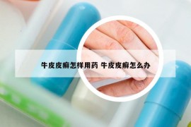 牛皮皮癣怎样用药 牛皮皮癣怎么办