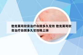 他克莫司软膏治疗白斑多久见效 他克莫司软膏治疗白斑多久见效晚上抹