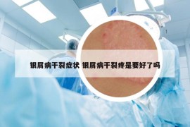银屑病干裂症状 银屑病干裂疼是要好了吗