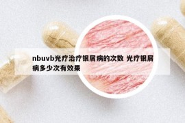 nbuvb光疗治疗银屑病的次数 光疗银屑病多少次有效果
