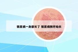 银屑病一身都长了 银屑病刚开始长