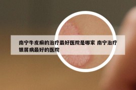 南宁牛皮癣的治疗最好医院是哪家 南宁治疗银屑病最好的医院