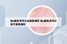 维a酸乳膏可以治银屑病吗 维a酸乳膏可以用于银屑病吗