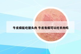 牛皮癣能吃猪头肉 牛皮有癣可以吃羊肉吗
