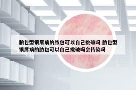 脓包型银屑病的脓包可以自己挑破吗 脓包型银屑病的脓包可以自己挑破吗会传染吗