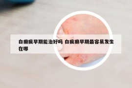 白癫疯早期能治好吗 白疯癫早期最容易发生在哪