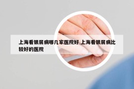 上海看银屑病哪几家医院好 上海看银屑病比较好的医院