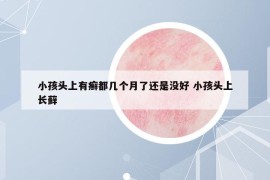 小孩头上有癣都几个月了还是没好 小孩头上长藓