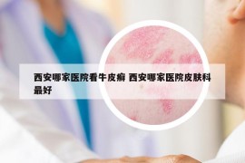 西安哪家医院看牛皮癣 西安哪家医院皮肤科最好