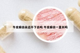 牛皮癣会永远不下去吗 牛皮癣会一直长吗