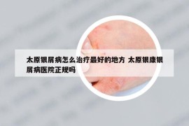 太原银屑病怎么治疗最好的地方 太原银康银屑病医院正规吗