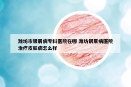 潍坊市银屑病专科医院在哪 潍坊银屑病医院治疗皮肤病怎么样