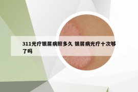 311光疗银屑病照多久 银屑病光疗十次够了吗