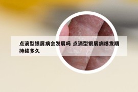 点滴型银屑病会发展吗 点滴型银屑病爆发期持续多久