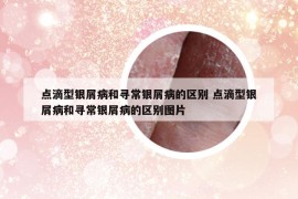 点滴型银屑病和寻常银屑病的区别 点滴型银屑病和寻常银屑病的区别图片