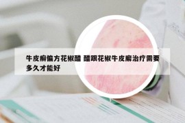 牛皮癣偏方花椒醋 醋跟花椒牛皮廨治疗需要多久才能好