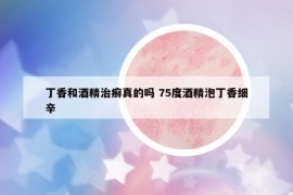 丁香和酒精治癣真的吗 75度酒精泡丁香细辛