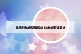 局限形脓疱型银屑病 脓疱病型银屑病
