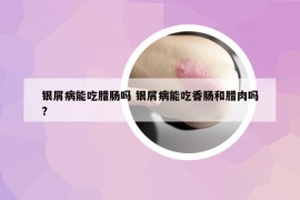 银屑病能吃腊肠吗 银屑病能吃香肠和腊肉吗?