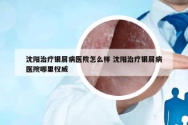 沈阳治疗银屑病医院怎么样 沈阳治疗银屑病医院哪里权威