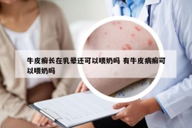 牛皮癣长在乳晕还可以喂奶吗 有牛皮病癣可以喂奶吗