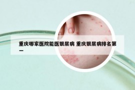 重庆哪家医院能医银屑病 重庆银屑病排名第一
