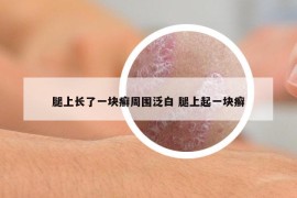 腿上长了一块癣周围泛白 腿上起一块癣