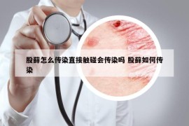 股藓怎么传染直接触碰会传染吗 股藓如何传染