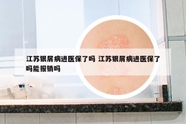 江苏银屑病进医保了吗 江苏银屑病进医保了吗能报销吗