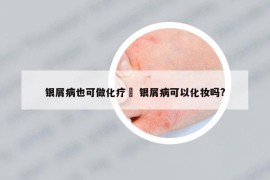 银屑病也可做化疗嗎 银屑病可以化妆吗?