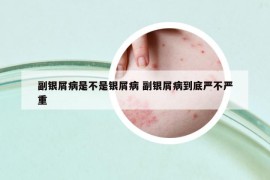 副银屑病是不是银屑病 副银屑病到底严不严重