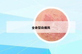 全身型白癜风