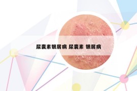 尿囊素银屑病 尿囊素 银屑病