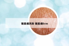 银屑病天敌 银屑病trm