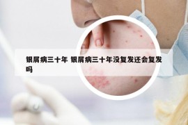 银屑病三十年 银屑病三十年没复发还会复发吗