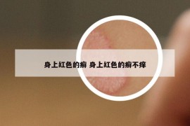 身上红色的癣 身上红色的癣不痒