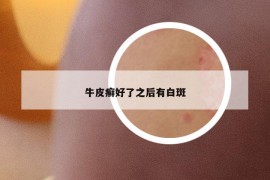 牛皮癣好了之后有白斑