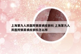 上海第九人民医院银屑病皮肤科 上海第九人民医院银屑病皮肤科怎么样