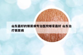 山东最好的银屑病专治医院哪家最好 山东治疗银屑病