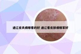 通辽皮夫病哪看的好 通辽看皮肤病哪家好