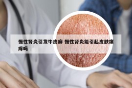 慢性肾炎引发牛皮癣 慢性肾炎能引起皮肤瘙痒吗