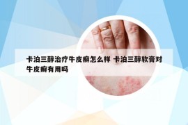卡泊三醇治疗牛皮癣怎么样 卡泊三醇软膏对牛皮癣有用吗