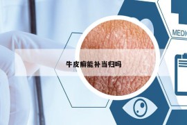 牛皮癣能补当归吗