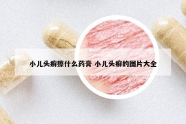 小儿头癣擦什么药膏 小儿头癣的图片大全